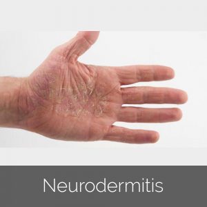 Neurodermitis